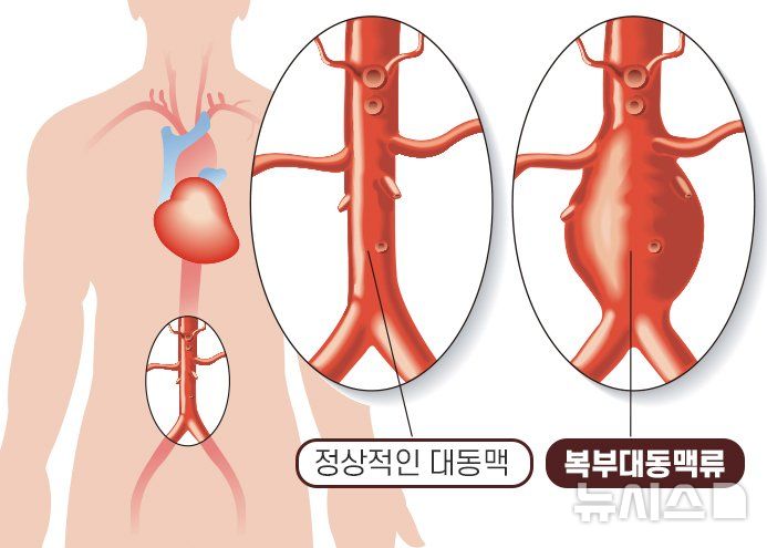 배에서 '쿵쿵' 박동소리…혹시 '이 질환' 신호?[몸의경고]