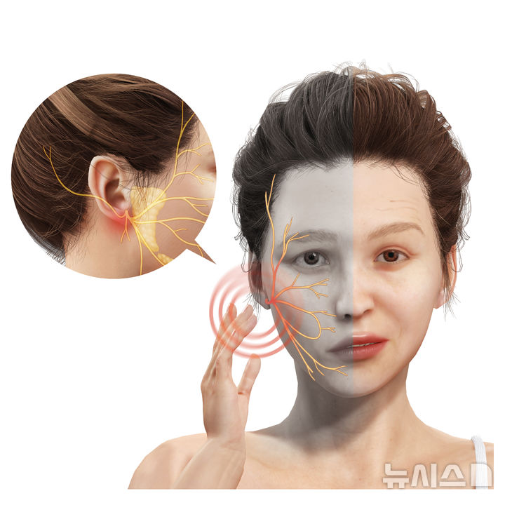 "이마 주름이 갑자기 펴졌어요"…'안면마비' 초기 증상?