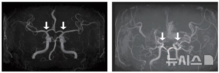 소아 모야모야병, 유병률 늘고…치명적 합병증은 40%↓