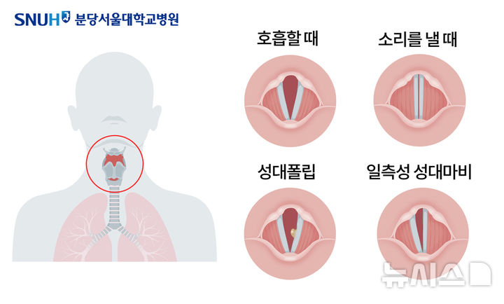 "목소리 안나와요"…감기인 줄 알았는데 혹시 '이 질환'?[몸의경고]