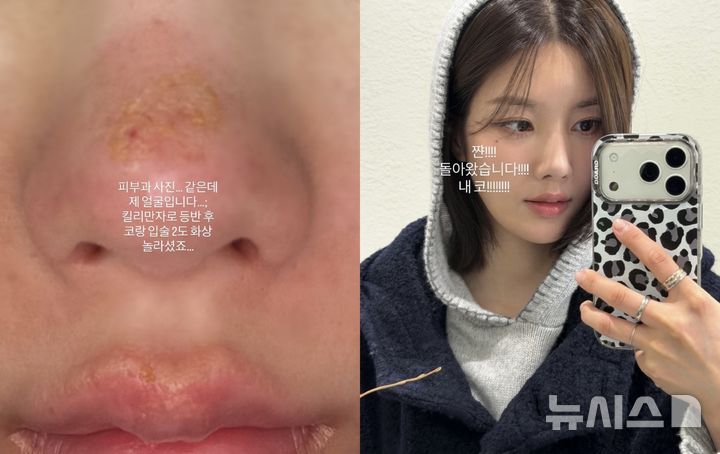 '킬리만자로行' 권은비, 얼굴에 2도 화상…