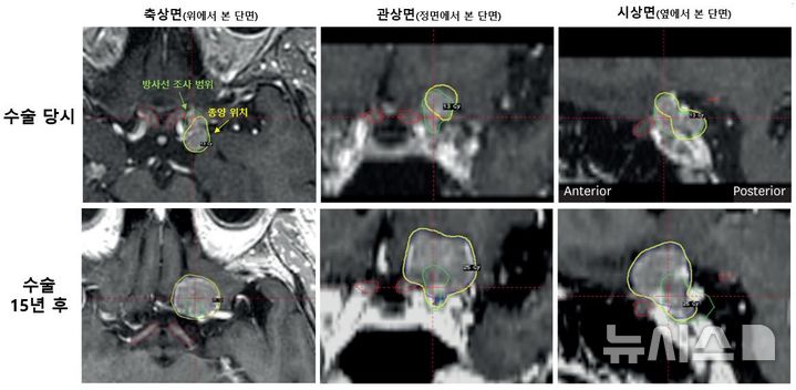 부작용 피하려 방사선 줄였더니…10년 뒤 시력 저하