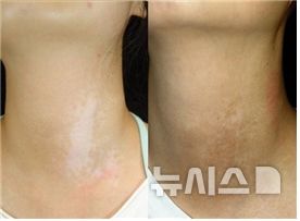 "피부에 갑자기 하얀 반점이 생겼어요"…혹시 '이 질환'? [몸의경고]