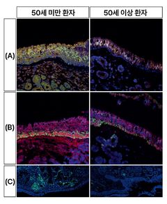 두개저내시경 수술후 후각저하?…"나이에 따라 달라요"
