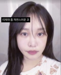 "눈밑지+코성형 1개월"…랄랄, 확 달라진 비주얼 공개