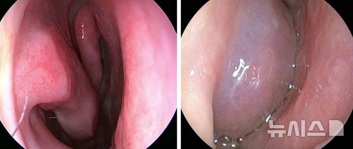 꽃구경 갔다 '간질간질'…"꽃가루 알레르기, 예방법은?"