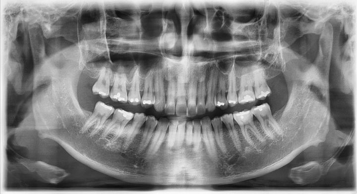 6000만 원 아끼려 튀르키예행…원정 시술 후 '치아 전부 발치'된 영국 男