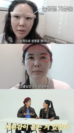 장영란 "눈썹 밑 거상 후 자신감 생기고 너무 행복해"