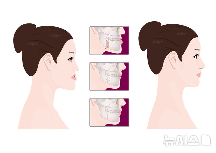"예뻐질래요" 양악수술 신경손상…AI가 미리 차단 
