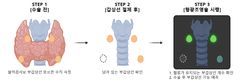 갑상선암 수술 후 목소리변화…이 검사로 미리 안다