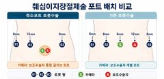 "절개구멍 줄여 1시간 단축"…신 로봇수술 성과