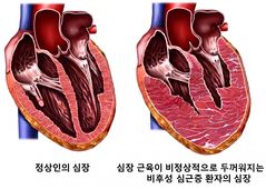 '이 질환' 저위험군의 돌연사…원인은 왼쪽 심장