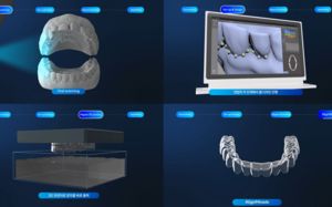이젠 치아 교정도 AI로…"이물감 없어요"