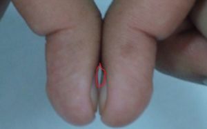 손톱 붙였는데 '이 틈' 없으면…폐암 초기 징후 의심