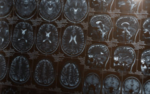 뇌졸중 새 치료법 찾았다…韓연구진 신약 개발