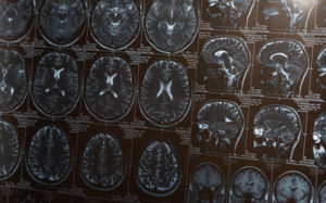 뇌졸중 새 치료법 찾았다…韓연구진 신약 개발