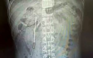 어쩐지 계속 아프더라…20년 전 삼킨 체온계가 뱃속에